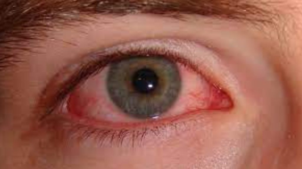 Punjab Pink Eye Surge: How to Stay Safe from Conjunctivitis